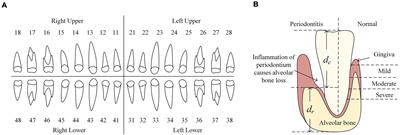 An Interpretable Computer-Aided Diagnosis Method for Periodontitis From Panoramic Radiographs